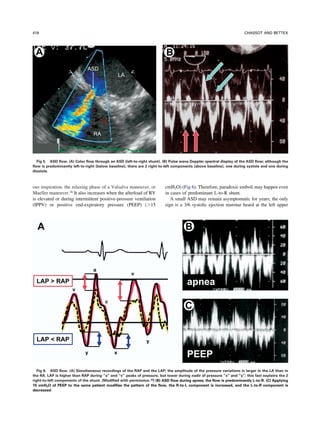Asd Color Flow Anesthesia And Congenital Heart Disease | PDF