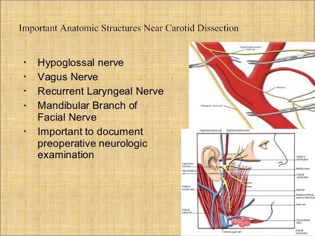 carotid endarterectomy anesthesia