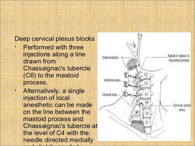 carotid endarterectomy anesthesia