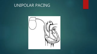 UNIPOLAR PACING
 