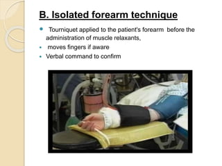 B. Isolated forearm technique
 Tourniquet applied to the patient's forearm before the
administration of muscle relaxants,
 moves fingers if aware
 Verbal command to confirm
 