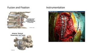 Fusion and Fixation Instrumentation
 