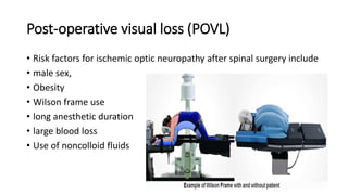 Post-operative visual loss (POVL)
• Risk factors for ischemic optic neuropathy after spinal surgery include
• male sex,
• Obesity
• Wilson frame use
• long anesthetic duration
• large blood loss
• Use of noncolloid fluids
 