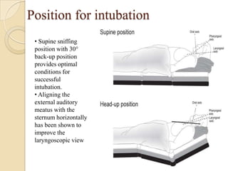 Position for intubation
 • Supine sniffing
 position with 30°
 back-up position
 provides optimal
 conditions for
 successful
 intubation.
 • Aligning the
 external auditory
 meatus with the
 sternum horizontally
 has been shown to
 improve the
 laryngoscopic view
 