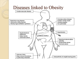 Diseases linked to Obesity
 