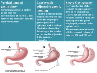 RestrictiveLaproscopic
Vertical banded         Type                                   Sleeve Gastrectomy
                                                               Decrease the size of the
gastroplasty                      adjustable gastric
Surgical creation of a gastric                                 stomach to approximately
                                  banding                      20% of its original size
pouch that can                      In this a band is placed
accommodate 25 to 30 mL and                                    Gastric fundus and body is
                                  around the stomach just      resected to form a tube like
restricts the amount of food that below the esophageal
can be consumed                                                opening from the gastro
                                  gastric junction &           esophageal junction to the
                                  tightened with a balloon     pyloric valve.
                                  filled with 15ml saline.     The reconstructed stomach
                                  Advantages: the tension      will have a total volume of
                                  on the band is adjustable    between 100 and 200 mL.
                                  & the system is
                                  removable
 