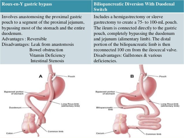 Anesthesia for bariatric surgery