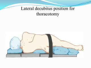 Lateral decubitus position for
         thoracotomy
 