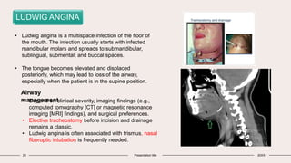 25 Presentation title 20XX
LUDWIG ANGINA
• Ludwig angina is a multispace infection of the floor of
the mouth. The infection usually starts with infected
mandibular molars and spreads to submandibular,
sublingual, submental, and buccal spaces.
• The tongue becomes elevated and displaced
posteriorly, which may lead to loss of the airway,
especially when the patient is in the supine position.
Airway
management
• Depend on clinical severity, imaging findings (e.g.,
computed tomography [CT] or magnetic resonance
imaging [MRI] findings), and surgical preferences.
• Elective tracheostomy before incision and drainage
remains a classic.
• Ludwig angina is often associated with trismus, nasal
fiberoptic intubation is frequently needed.
 