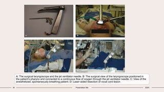 34 Presentation title 20XX
A: The surgical laryngoscope and the jet ventilator needle. B: The surgical view of the laryngoscope positioned in
the patient’s pharynx and connected to a continuous flow of oxygen through the jet ventilator needle. C: View of the
anesthetized, spontaneously breathing patient. D: Laser-aided resection of vocal cord lesion
 