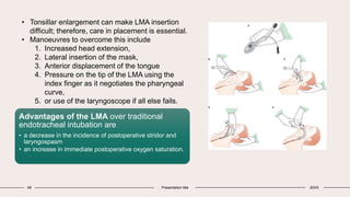 48 Presentation title 20XX
• Tonsillar enlargement can make LMA insertion
difficult; therefore, care in placement is essential.
• Manoeuvres to overcome this include
1. Increased head extension,
2. Lateral insertion of the mask,
3. Anterior displacement of the tongue
4. Pressure on the tip of the LMA using the
index finger as it negotiates the pharyngeal
curve,
5. or use of the laryngoscope if all else fails.
Advantages of the LMA over traditional
endotracheal intubation are
• a decrease in the incidence of postoperative stridor and
laryngospasm
• an increase in immediate postoperative oxygen saturation.
 
