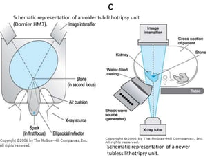 c
Schematic representation of a newer
tubless lithotripsy unit.
Schematic representation of an older tub lithotripsy unit
(Dornier HM3).
 