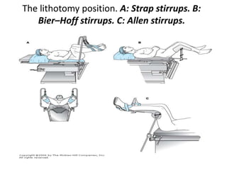 The lithotomy position. A: Strap stirrups. B:
Bier–Hoff stirrups. C: Allen stirrups.
 