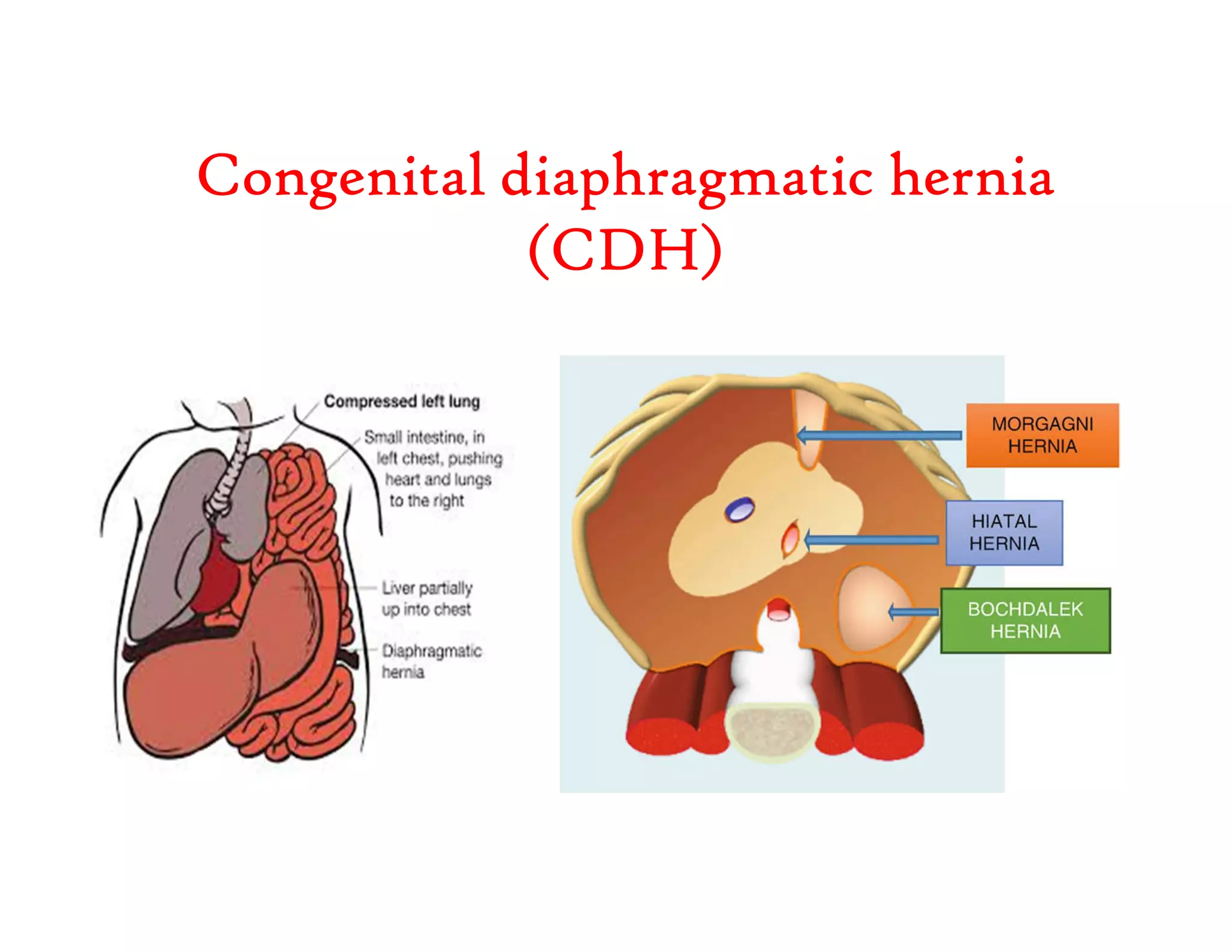 Anesthesia for Neonatal congenital correction surgery.pdf