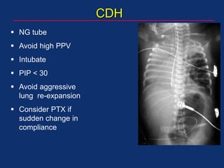 CDH
 NG tube
 Avoid high PPV
 Intubate
 PIP < 30
 Avoid aggressive
lung re-expansion
 Consider PTX if
sudden change in
compliance
 