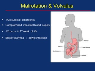  True surgical emergency
 Compromised intestinal blood supply
 1/3 occur in 1st
week of life
 Bloody diarrhea → bowel infarction
Malrotation & Volvulus
 
