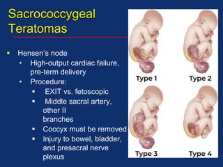 Sacrococcygeal
Teratomas
 Hensen’s node
• High-output cardiac failure,
pre-term delivery
• Procedure:
 EXIT vs. fetoscopic
 Middle sacral artery,
other II
branches
 Coccyx must be removed
 Injury to bowel, bladder,
and presacral nerve
plexus
 
