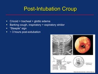 Post-Intubation Croup
 Cricoid > tracheal > glottic edema
 Barking cough, inspiratory + expiratory stridor
 “Steeple” sign
 ~ 3 hours post-extubation
 