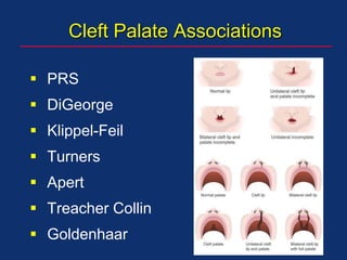 Cleft Palate Associations
 PRS
 DiGeorge
 Klippel-Feil
 Turners
 Apert
 Treacher Collin
 Goldenhaar
 