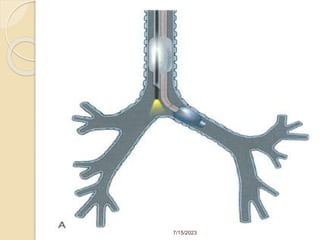 Anesthesia for thoracic surgery (2).pptx