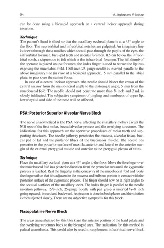 94
can be done using a bicuspid approach or a central incisor approach during
insertion.
Technique
The patient’s head is tilted so that the maxillary occlusal plane is at a 45° angle to
the floor. The supraorbital and infraorbital notches are palpated. An imaginary line
is drawn through these notches which should pass through the pupils of the eyes, the
infraorbital foramen, bicuspid teeth and mental foramen. 0.5 cm below the infraor-
bital notch, a depression is felt which is the infraorbital foramen. The left thumb of
the operator is placed on the foramen, the index finger is used to retract the lip thus
exposing the mucolabial fold. 1 5/8-inch 25-gauge needle is inserted parallel to the
above imaginary line (in case of a bicuspid approach), 5 mm parallel to the labial
plate, to pass over the canine fossa.
In case of a central incisor approach, the needle should bisect the crown of the
central incisor from the mesioincisal angle to the distoangle angle, 5 mm from the
mucobuccal fold. The needle should not penetrate more than ¾ inch and 2 mL is
slowly infiltrated. The subjective symptoms of tingling and numbness of upper lip,
lower eyelid and side of the nose will be affected.
PSA: Posterior Superior Alveolar Nerve Block
The nerve anaesthetized is the PSA nerve affecting the maxillary molars except the
MB root of the first molar, buccal alveolar process and the overlying structures. The
indications for this approach are the operative procedures of molar teeth and sup-
porting structures. The needle pathway penetrates the mucosa, alveolar tissue, buc-
cal pad of fat and the posterior fibres of the buccinator muscle. The needle lies
posterior to the posterior surface of maxilla, anterior and lateral to the anterior mar-
gin of the external pterygoid muscle and anterior to the pterygoid plexus of veins.
Technique
Place the maxillary occlusal plane at a 45° angle to the floor. Move the forefinger over
the mucobuccal fold in a posterior direction from the premolar area until the zygomatic
process is reached. Rest the fingertip in the concavity of the mucobuccal fold and rotate
the fingernail so that it is adjacent to the mucosa and bulbous portion in contact with the
posterior surface of the zygomatic process. The finger should now be at right angles to
the occlusal surfaces of the maxillary teeth. The index finger is parallel to the needle
insertion pathway. 15/8-inch, 25-gauge needle with pen grasp is inserted ½–¾ inch
going upward, inward and backward.Aspiration is done in both planes and the solution
is then injected slowly. There are no subjective symptoms for this block.
Nasopalatine Nerve Block
The areas anaesthetized by this block are the anterior portion of the hard palate and
the overlying structures back to the bicuspid area. The indication for this method is
palatal anaesthesia. This could also be used to supplement infraorbital nerve block
A. Jagtap and V. Jagtap
 