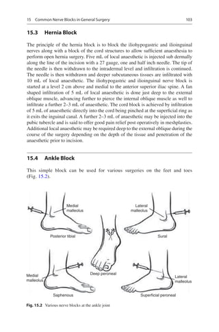 103
15.3	 Hernia Block
The principle of the hernia block is to block the iliohypogastric and ilioinguinal
nerves along with a block of the cord structures to allow sufficient anaesthesia to
perform open hernia surgery. Five mL of local anaesthetic is injected sub dermally
along the line of the incision with a 27 gauge, one and half inch needle. The tip of
the needle is then withdrawn to the intradermal level and infiltration is continued.
The needle is then withdrawn and deeper subcutaneous tissues are infiltrated with
10  mL of local anaesthetic. The iliohypogastric and ilioinguinal nerve block is
started at a level 2 cm above and medial to the anterior superior iliac spine. A fan
shaped infiltration of 5 mL of local anaesthetic is done just deep to the external
oblique muscle, advancing further to pierce the internal oblique muscle as well to
infiltrate a further 2–3 mL of anaesthetic. The cord block is achieved by infiltration
of 5 mL of anaesthetic directly into the cord being pinched at the superficial ring as
it exits the inguinal canal. A further 2–3 mL of anaesthetic may be injected into the
pubic tubercle and is said to offer good pain relief post operatively in meshplasties.
Additional local anaesthetic may be required deep to the external oblique during the
course of the surgery depending on the depth of the tissue and penetration of the
anaesthetic prior to incision.
15.4	 Ankle Block
This simple block can be used for various surgeries on the feet and toes
(Fig. 15.2).
Medial
malleolus
Medial
malleolus
Deep peroneal
Posterior tibial Sural
Saphenous Superficial peroneal
Lateral
malleolus
Lateral
malleolus
Fig. 15.2  Various nerve blocks at the ankle joint
15  Common Nerve Blocks in General Surgery
 