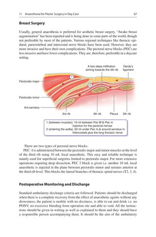 67
Breast Surgery
Usually, general anaesthesia is preferred for aesthetic breast surgery. “Awake breast
augmentation” has been reported and is being done in some parts of the world, though
not preferable by most of the patients. Various regional techniques like thoracic epi-
dural, paravertebral and intercostal nerve blocks have been used. However, they are
more invasive and have their own complications. The pectoral nerve blocks (PEC) are
less invasive and have fewer complications. They are, therefore, preferable in a daycare
setting.
A two steps infiltration
aiming towards the 4th rib
Pectoralis major
Pectoralis minor
Ant.serratus
3rd rib 4th rib 5th ribPleura
Gerdy’s
ligament
1
2
1 (between muscles): 10 ml between Pec M  Pec m
Injection for the pectoral nerves
2 (entering the axilla): 20 ml under Pec m  around serratus m
Intercostals plus the long thoracic nerve
There are two types of pectoral nerve blocks.
PEC -I is administered between the pectoralis major and minor muscles at the level
of the third rib using 10 mL local anaesthetic. This easy and reliable technique is
mainly used for superficial surgeries limited to pectoralis major. For more extensive
operations requiring deep dissection, PEC 2 block is given i.e. another 10 mL local
anaesthetic is injected in the plane between pectoralis minor and serratus anterior at
the third rib level. This blocks the lateral branches of thoracic spinal nerves (T2, 3, 4).
Postoperative Monitoring and Discharge
Standard ambulatory discharge criteria are followed. Patients should be discharged
when there is a complete recovery from the effect of anaesthetic agents without any
drowsiness, the patient is mobile with no dizziness, is able to eat and drink i.e. no
PONV, no excessive bleeding from operation site and able to void. All the instruc-
tions should be given in writing as well as explained to them and they should have
a responsible person accompanying them. It should be the aim of the ambulatory
11  Anaesthesia for Plastic Surgery in Day Care
 