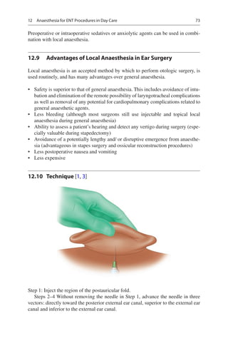 73
Preoperative or intraoperative sedatives or anxiolytic agents can be used in combi-
nation with local anaesthesia.
12.9	 Advantages of Local Anaesthesia in Ear Surgery
Local anaesthesia is an accepted method by which to perform otologic surgery, is
used routinely, and has many advantages over general anaesthesia.
•	 Safety is superior to that of general anaesthesia. This includes avoidance of intu-
bation and elimination of the remote possibility of laryngotracheal complications
as well as removal of any potential for cardiopulmonary complications related to
general anaesthetic agents.
•	 Less bleeding (although most surgeons still use injectable and topical local
anaesthesia during general anaesthesia)
•	 Ability to assess a patient’s hearing and detect any vertigo during surgery (espe-
cially valuable during stapedectomy)
•	 Avoidance of a potentially lengthy and/ or disruptive emergence from anaesthe-
sia (advantageous in stapes surgery and ossicular reconstruction procedures)
•	 Less postoperative nausea and vomiting
•	 Less expensive
12.10	 Technique [1, 3]
Step 1: Inject the region of the postauricular fold.
Steps 2–4 Without removing the needle in Step 1, advance the needle in three
vectors: directly toward the posterior external ear canal, superior to the external ear
canal and inferior to the external ear canal.
12  Anaesthesia for ENT Procedures in Day Care
 