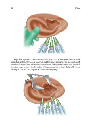 74
2
3
4
Steps 5–8: Inject the four quadrants of the ear canal in a stepwise fashion. This
anaesthetises the external ear canal while at the same time achieving haemostasis of
the skin of the ear canal and tympanic membrane. Take care during each of the canal
injection steps to avoid the formation of haematomas or vesicles that could impair
healing or obscure the tympanic membrane during surgery.
5
8
6 7
K. Vora
 