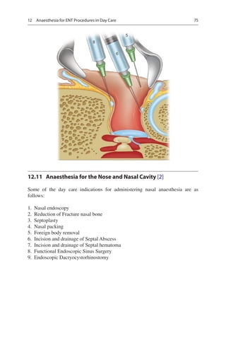 75
8
6
5
12.11	 Anaesthesia for the Nose and Nasal Cavity [2]
Some of the day care indications for administering nasal anaesthesia are as
follows:
	1.	 Nasal endoscopy
	2.	 Reduction of Fracture nasal bone
	3.	 Septoplasty
	4.	 Nasal packing
	5.	 Foreign body removal
	6.	 Incision and drainage of Septal Abscess
	7.	 Incision and drainage of Septal hematoma
	8.	 Functional Endoscopic Sinus Surgery
	9.	 Endoscopic Dacryocystorhinostomy
12  Anaesthesia for ENT Procedures in Day Care
 