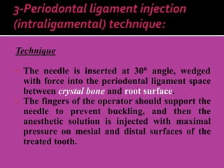Technique
 The needle is inserted at 30 angle, wedged
with force into the periodontal ligament space
between crystal bone and root surface.
 The fingers of the operator should support the
needle to prevent buckling, and then the
anesthetic solution is injected with maximal
pressure on mesial and distal surfaces of the
treated tooth.
 