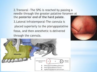 2.Transoral -The SPG is reached by passing a
needle through the greater palatine foramen at
the posterior end of the hard palate.
3.Lateral Infratemporal-The cannula is
placed superiorly to the pterygopalatine
fossa, and then anesthetic is delivered
through the cannula.
 