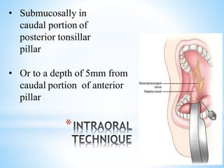 *
• Submucosally in
caudal portion of
posterior tonsillar
pillar
• Or to a depth of 5mm from
caudal portion of anterior
pillar
 