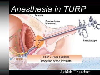 Ashish Dhandare
Anesthesia in TURP
 