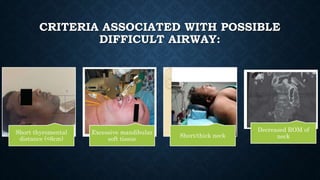 CRITERIA ASSOCIATED WITH POSSIBLE
DIFFICULT AIRWAY:
Short thyromental
distance (<6cm)
Excessive mandibular
soft tissue
Short/thick neck
Decreased ROM of
neck
 
