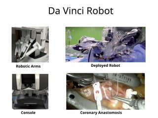 Da Vinci Robot
Deployed Robot
Robotic Arms
Console Coronary Anastomosis
 