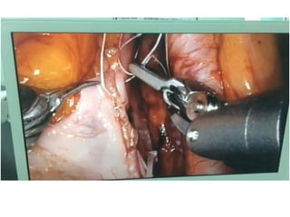 Anesthesia for robotic urology surgery's