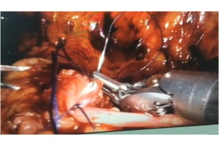 Anesthesia for robotic urology surgery's