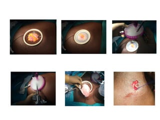 Anesthesia for robotic urology surgery's