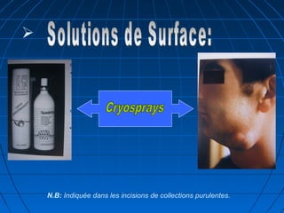 
N.B: Indiquée dans les incisions de collections purulentes.
 