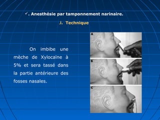 . Anesthésie par tamponnement narinaire.
i. Technique.
On imbibe une
mèche de Xylocaïne à
5% et sera tassé dans
la partie antérieure des
fosses nasales.
 