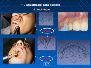  . Anesthésie para apicale
i. Technique.
VEST
PALA
2/3
 