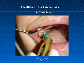  .Anesthésie intra ligamentaire.
ii. Technique.
2/2
 
