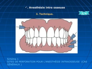 . Anesthésie intra osseuse
ii. Technique.
Schéma 1
SITES DE PERFORATION POUR L’ANESTHÉSIE INTRAOSSEUSE (CAS
GÉNÉRAUX )
2/4
 