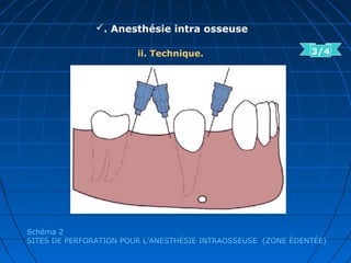 . Anesthésie intra osseuse
ii. Technique.
Schéma 2
SITES DE PERFORATION POUR L’ANESTHÉSIE INTRAOSSEUSE (ZONE ÉDENTÉE)
3/4
 