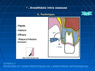 . Anesthésie intra osseuse
ii. Technique.
Schéma 3
PRINCIPES ET CARACTÉRISTIQUES DE L’ANESTHÉSIE INTRAOSSEUSE.
4/4
 