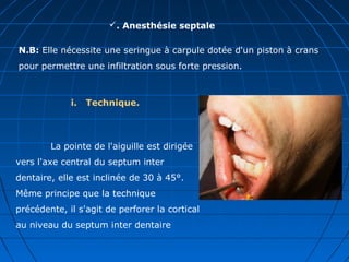 . Anesthésie septale
i. Technique.
N.B: Elle nécessite une seringue à carpule dotée d'un piston à crans
pour permettre une infiltration sous forte pression.
La pointe de l'aiguille est dirigée
vers l'axe central du septum inter
dentaire, elle est inclinée de 30 à 45°.
Même principe que la technique
précédente, il s'agit de perforer la cortical
au niveau du septum inter dentaire
 