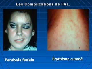 Paralysie facialeParalysie faciale Érythème cutanéÉrythème cutané
 