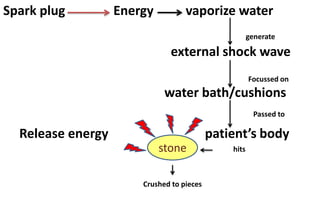 Spark plug Energy vaporize water
external shock wave
water bath/cushions
Release energy patient’s body
stone
generate
Focussed on
Passed to
hits
Crushed to pieces
 