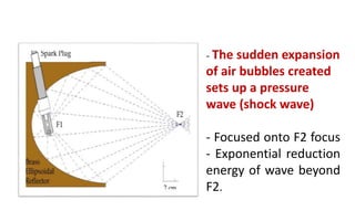 - The sudden expansion
of air bubbles created
sets up a pressure
wave (shock wave)
- Focused onto F2 focus
- Exponential reduction
energy of wave beyond
F2.
 